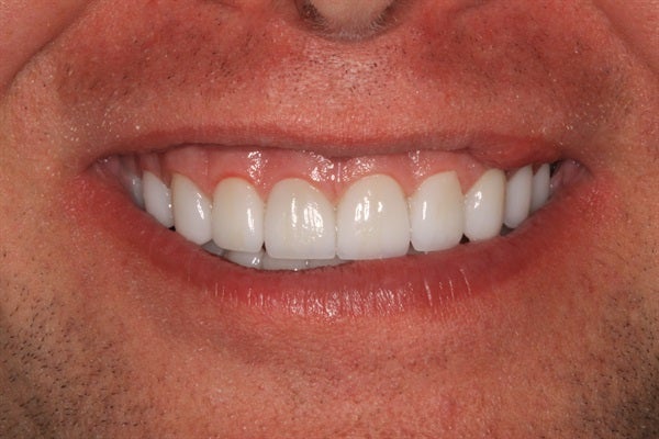 Full Mouth Rehabilitation - From Diagnosis to Delivery & Equilibration