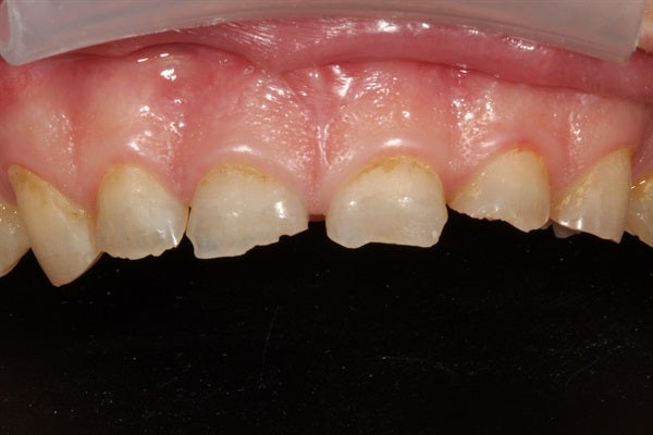 Full Mouth Rehabilitation - From Diagnosis to Delivery & Equilibration