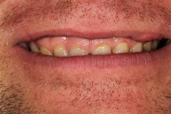 Full Mouth Rehabilitation - From Diagnosis to Delivery & Equilibration