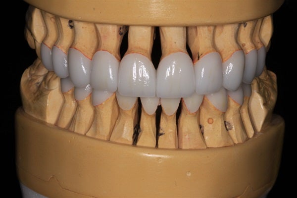 Full Mouth Rehabilitation - From Diagnosis to Delivery & Equilibration