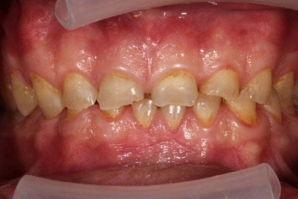 Full Mouth Rehabilitation - From Diagnosis to Delivery & Equilibration