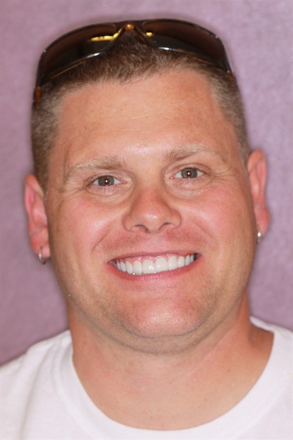 Full Mouth Rehabilitation - From Diagnosis to Delivery & Equilibration
