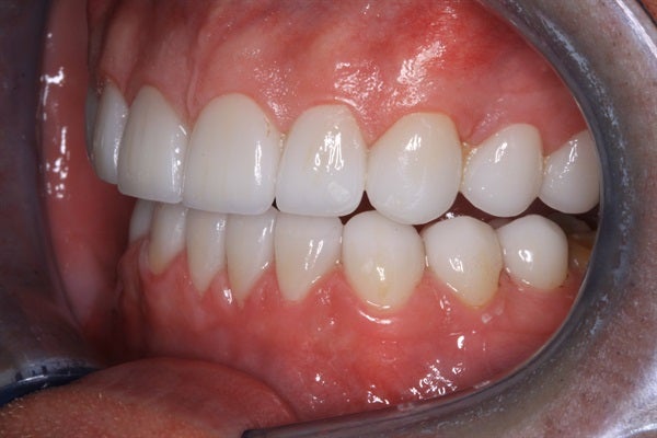 Full Mouth Rehabilitation - From Diagnosis to Delivery & Equilibration