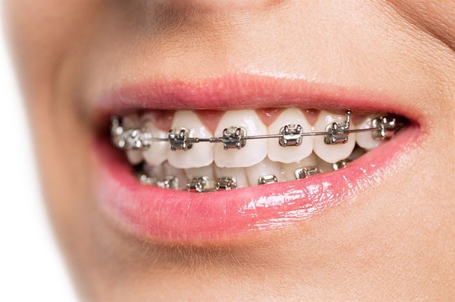Choosing the Right Braces: What You Need to Know