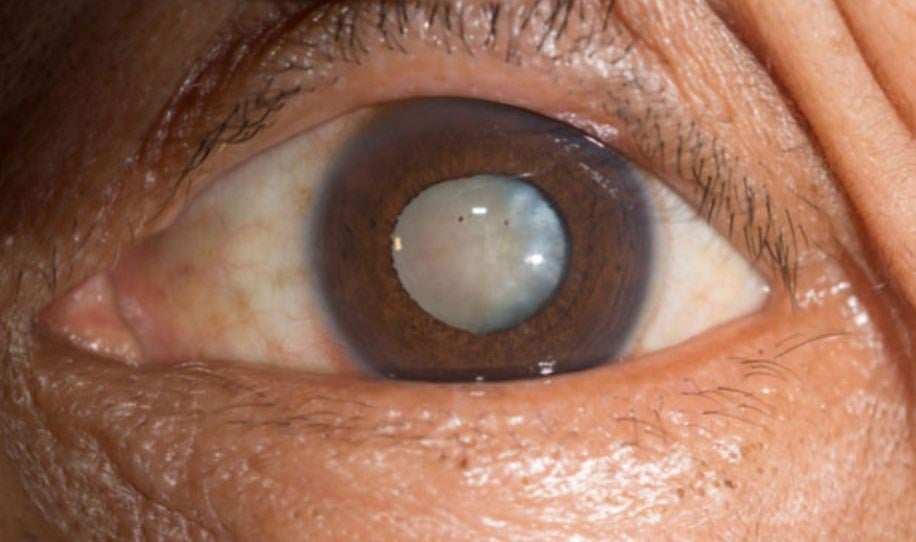 What to Expect From Cataract Surgery