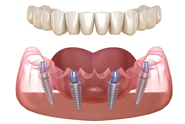 Montclair Dentist; Dental Implant Dentist New Jersey