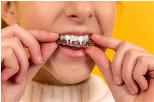 Everything You Should Know About Teeth Aligners