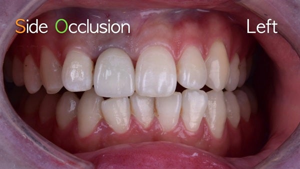 The   One-Time   Socket   Abutment Just    For   Incisor