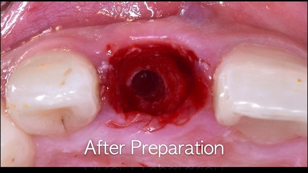 The   One-Time   Socket   Abutment Just    For   Incisor