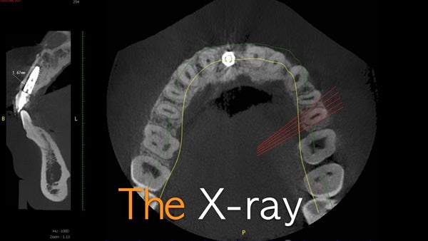 The   One-Time   Socket   Abutment Just    For   Incisor