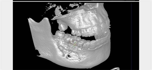 The Rct for big cyst
