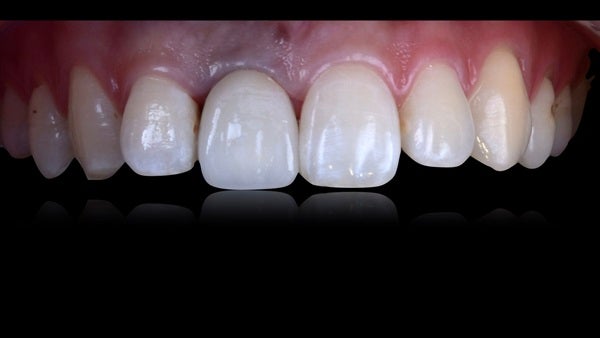 The   One-Time   Socket   Abutment Just    For   Incisor