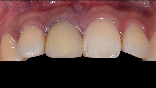 The   One-Time   Socket   Abutment Just    For   Incisor