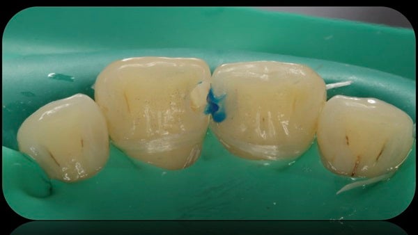 The Immediately  restoration of Central Incisor  on Lingual  Surface 
