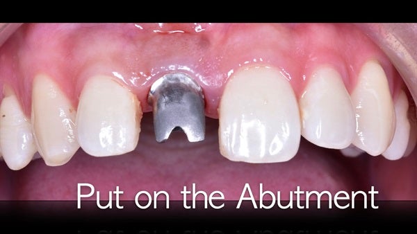 The   One-Time   Socket   Abutment Just    For   Incisor