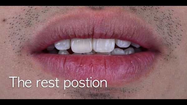 The   One-Time   Socket   Abutment Just    For   Incisor