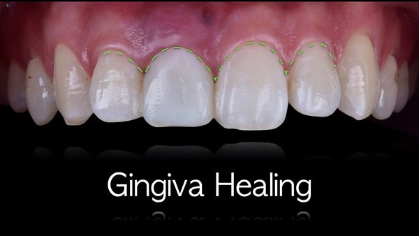 The   One-Time   Socket   Abutment Just    For   Incisor