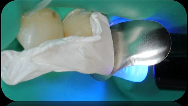 The Immediately  restoration of Central Incisor  on Lingual  Surface 