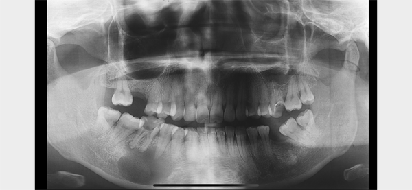 The Rct for big cyst