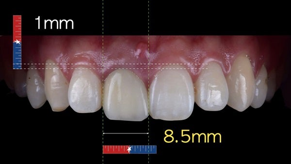 The   One-Time   Socket   Abutment Just    For   Incisor