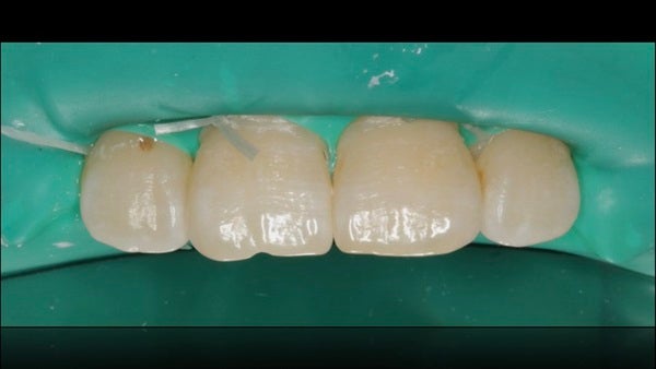 The Immediately  restoration of Central Incisor  on Lingual  Surface 