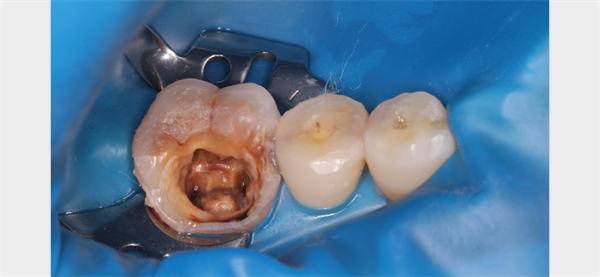 The Rct for big cyst
