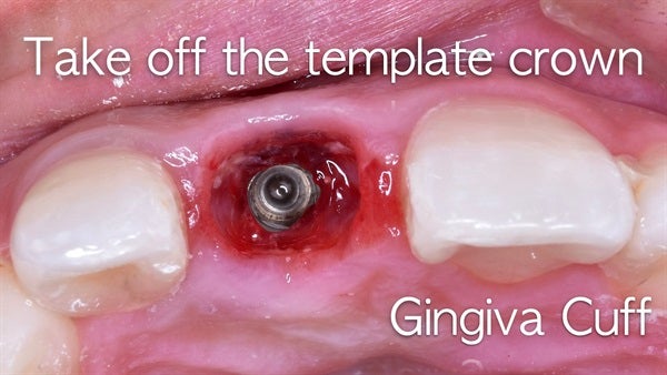 The   One-Time   Socket   Abutment Just    For   Incisor