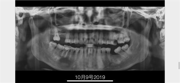 The Rct for big cyst