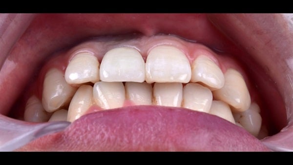 The   One-Time   Socket   Abutment Just    For   Incisor