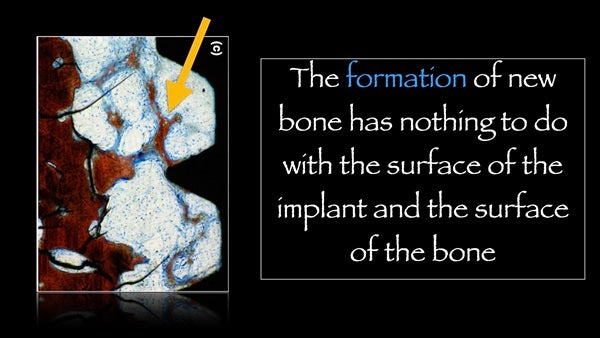 The   One-Time   Socket   Abutment Just    For   Incisor
