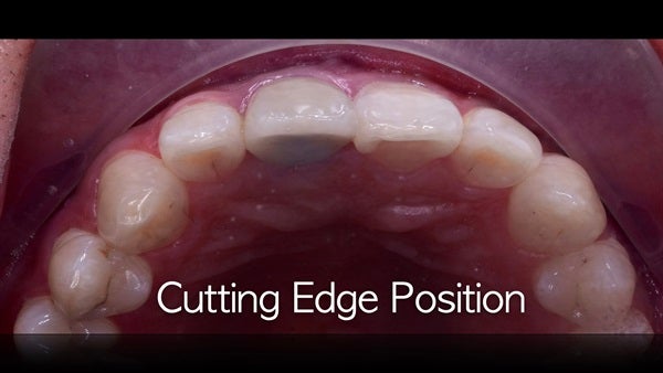 The   One-Time   Socket   Abutment Just    For   Incisor