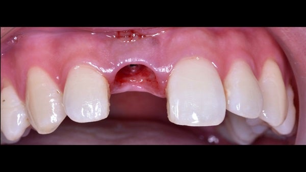 The   One-Time   Socket   Abutment Just    For   Incisor