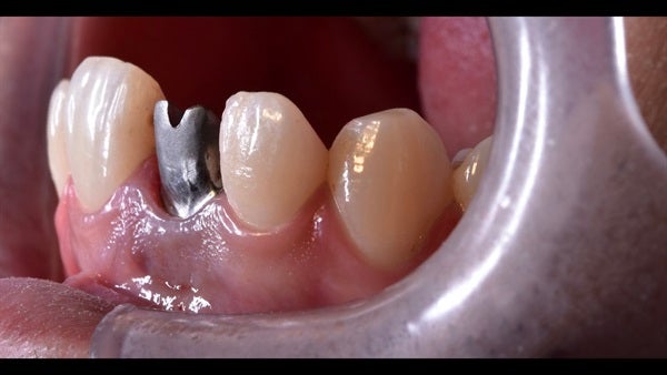 The   One-Time   Socket   Abutment Just    For   Incisor