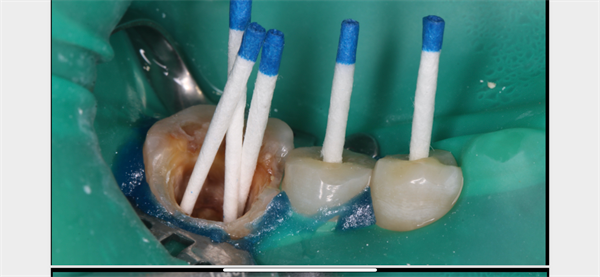 The Rct for big cyst