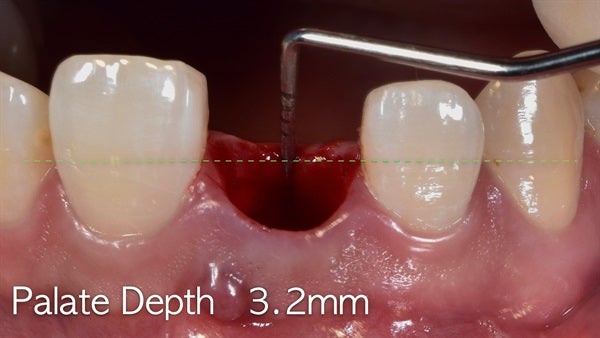 The   One-Time   Socket   Abutment Just    For   Incisor
