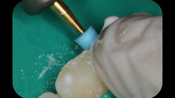 The Immediately  restoration of Central Incisor  on Lingual  Surface 