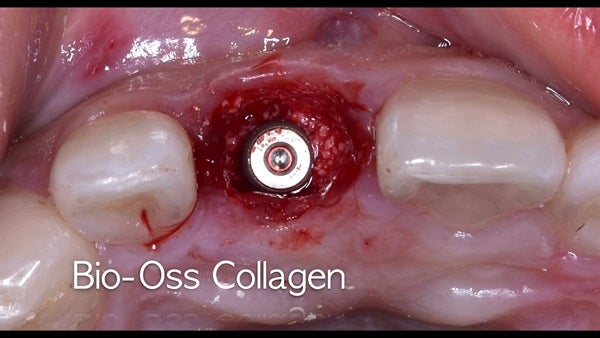 The   One-Time   Socket   Abutment Just    For   Incisor