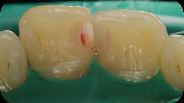 The Immediately  restoration of Central Incisor  on Lingual  Surface 