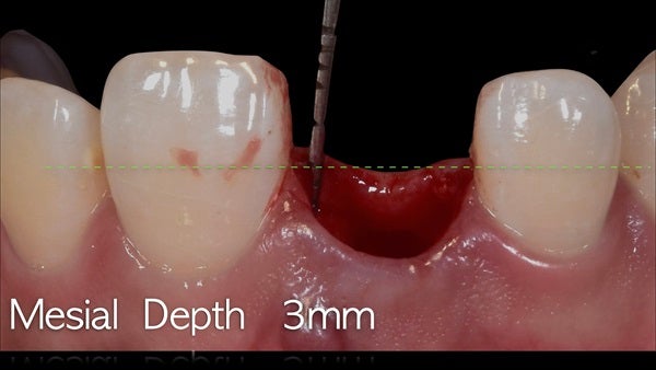 The   One-Time   Socket   Abutment Just    For   Incisor