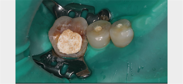 The Rct for big cyst