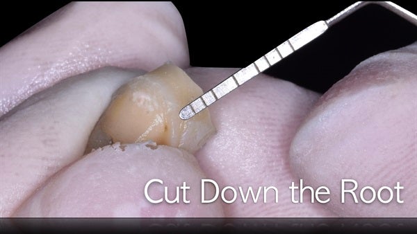 The   One-Time   Socket   Abutment Just    For   Incisor