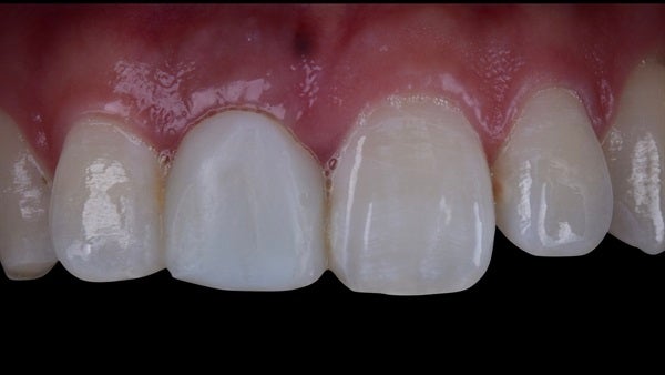 The   One-Time   Socket   Abutment Just    For   Incisor