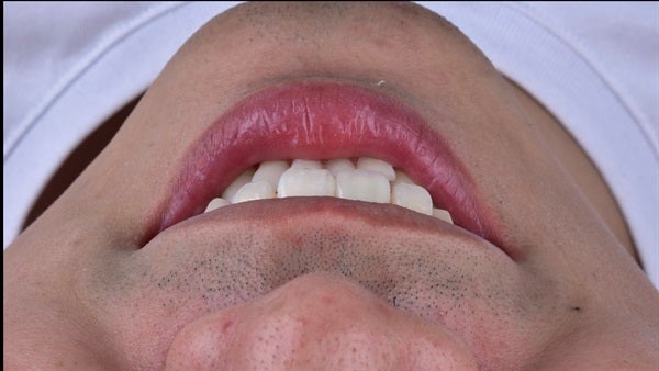 The   One-Time   Socket   Abutment Just    For   Incisor