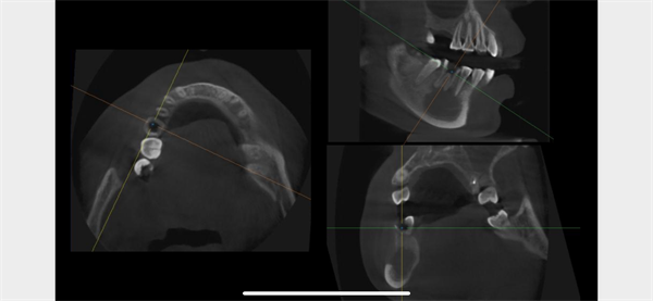 The Rct for big cyst