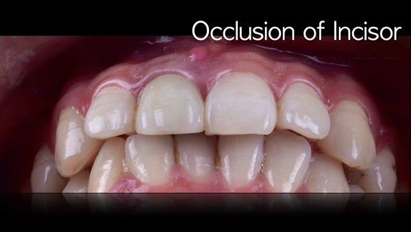 The   One-Time   Socket   Abutment Just    For   Incisor
