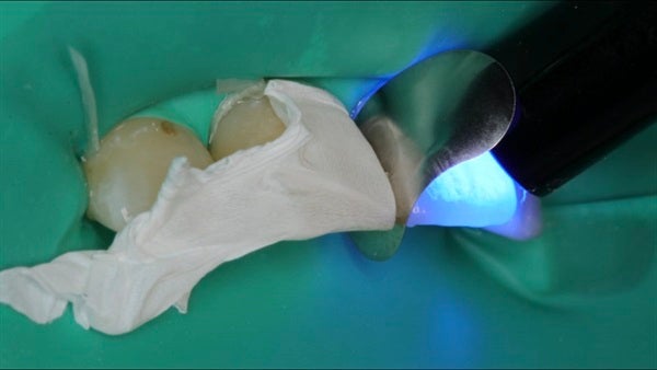 The Immediately  restoration of Central Incisor  on Lingual  Surface 
