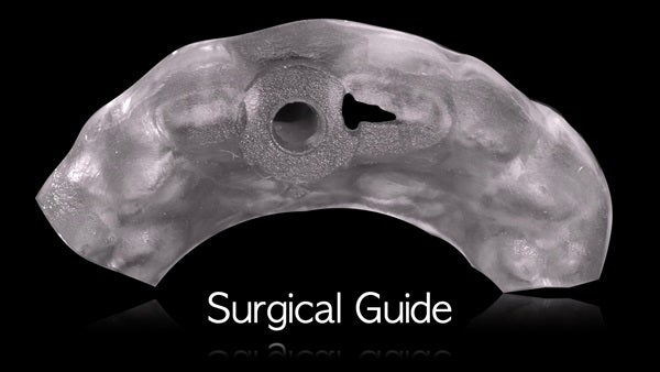 The   One-Time   Socket   Abutment Just    For   Incisor