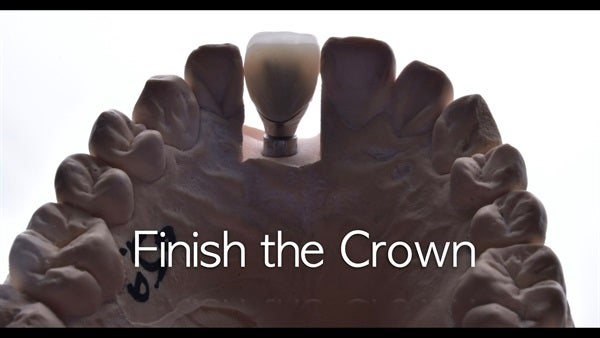 The   One-Time   Socket   Abutment Just    For   Incisor