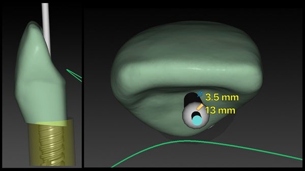The   One-Time   Socket   Abutment Just    For   Incisor