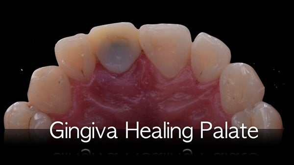The   One-Time   Socket   Abutment Just    For   Incisor